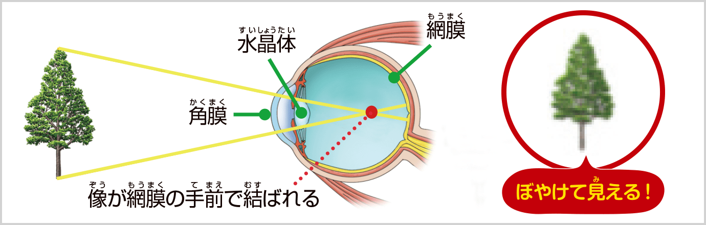 近視の場合