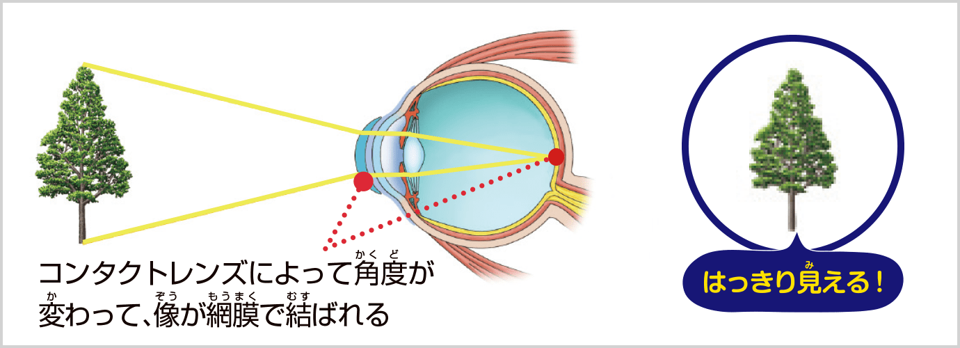 コンタクトレンズをつけると